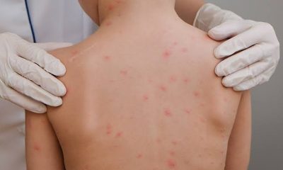 agora:-sarampo-avanca-no-tocantins-e-casos-ja-sao-registrados-tambem-em-palmas-e-porto-nacional