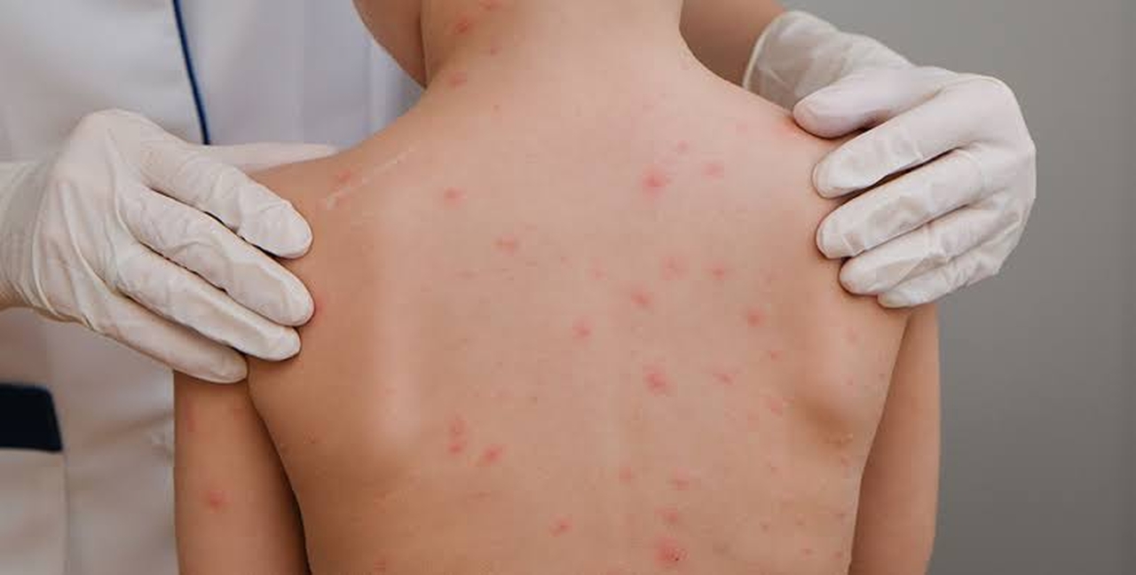 agora:-sarampo-avanca-no-tocantins-e-casos-ja-sao-registrados-tambem-em-palmas-e-porto-nacional